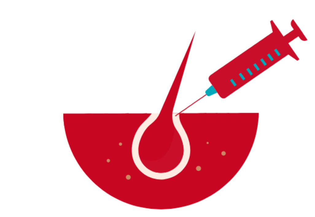 PRP Hair Loss